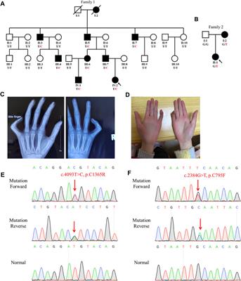 Case report: Identification of novel fibrillin-2 variants impacting disulfide bond and causing congenital contractural arachnodactyly